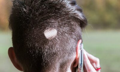 alopecia-areata-pelo-corto